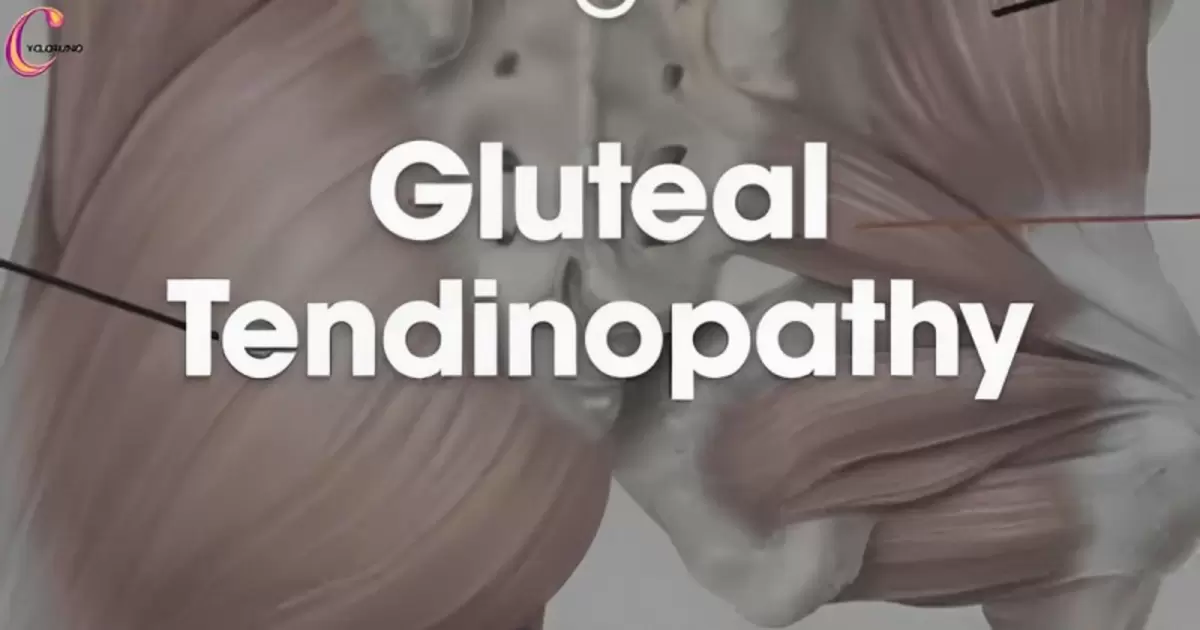 Is Cycling Good For Gluteal Tendinopathy?